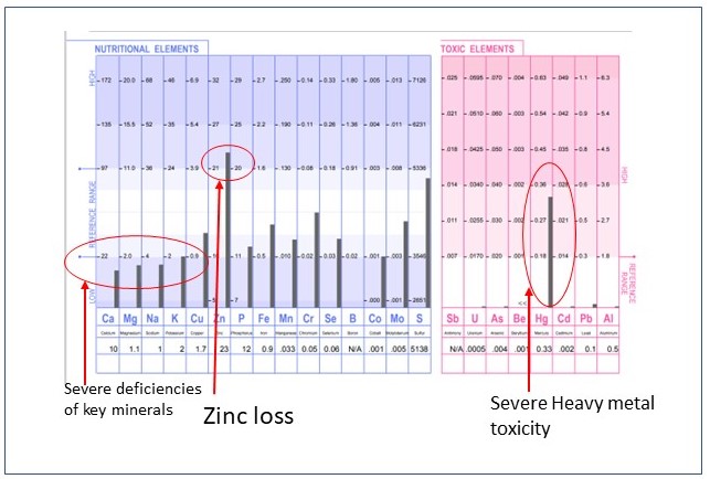 htma example adhd root causes and natural nutrition solutions from true foods nutrition